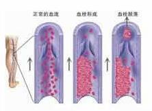 静脉血栓是如何一步步危及人生命的?