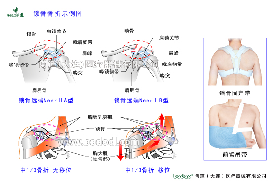 锁骨的常见伤病与健康防护
