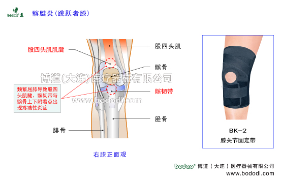 髌腱炎跳跃者，膝股四头肌肌腱炎，博道髌腱加压固定带，透气性膝关节加压固定带JK带膝关节固定带BK-2髌腱炎加压护膝排行榜，膑腱炎跳跃者膝股四头肌腱炎的病因与预防治疗，肌腱炎加压固定带哪家好。膝关节常见疾病博道透气护膝户外运动矫形保暖护膝，股骨髌骨膑腱髌韧带胫骨滑膜膝关节囊，膝关节矫正带髌前韧带髌下韧带，髌韧带长度及主要功能与作用，膝关节伸膝装置与屈膝装置。髌腱炎是长期劳损引起髌韧带上下附着点出现疼痛